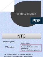 Coriocarcinoma Gestacional