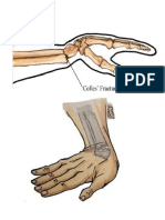 fractura de muñeca.docx