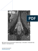 Fig. 2. Anatomy of Anal Canal. Contrast-Enhanced T1-Weighted Axial Image. 1 External Sphincter, 2 Internal Sphincter (High