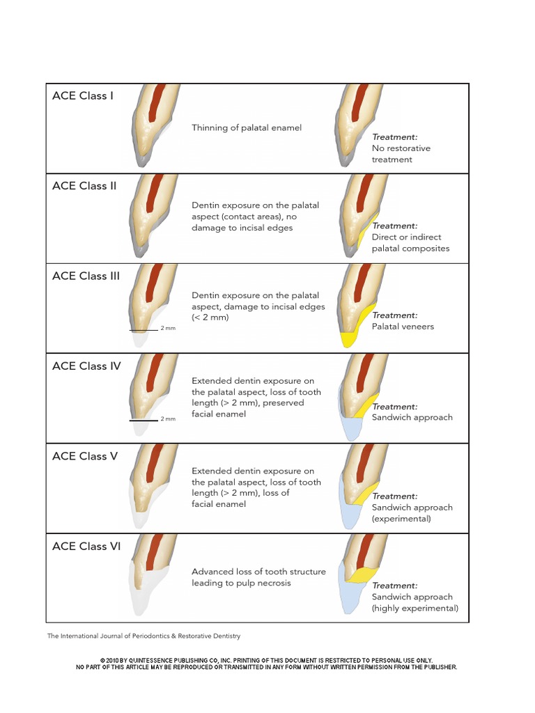 Ace Classification Tooth Enamel Tooth