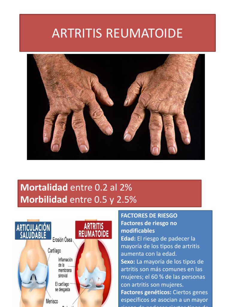 Artritis Reumatoide Artritis Reumatoide Artritis