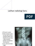 X-ray Paru Efusi Pleura Kiri