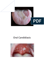 Oral Candidiasis