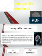 Tomografía Cerebral
