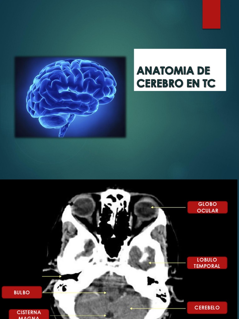 Anatomía Cerebral en Tomografía TC | PDF, image size:768x1024