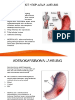 Penyakit Neoplasma Lambung