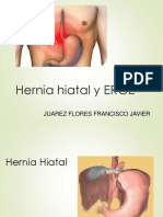 Hernia Hiatal y Erge