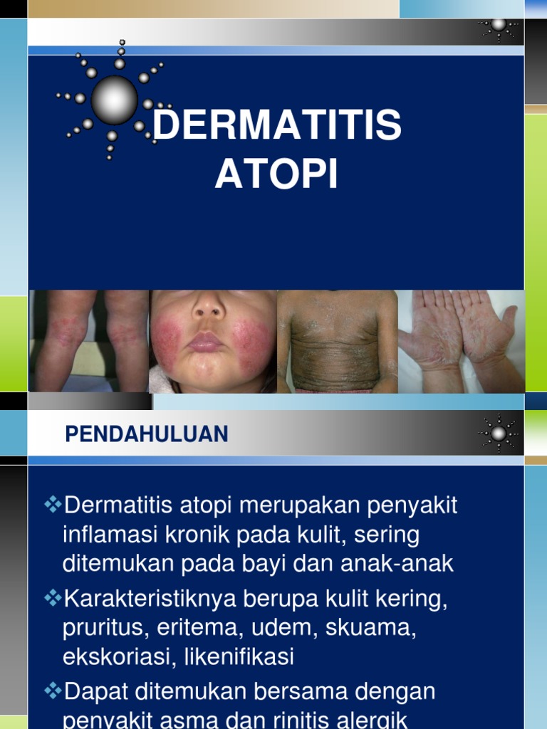 Dermatitis Atopi | PDF | Kesehatan Holistik | Sains & Matematika