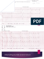 Alternating Bundle Branch Block