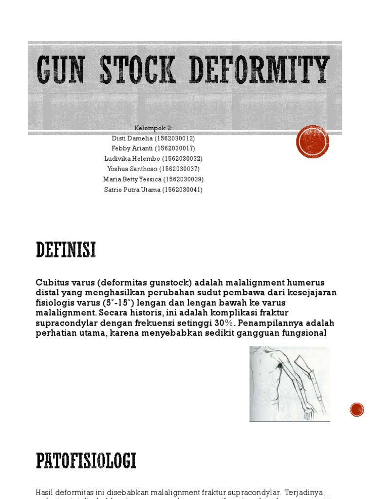 Gun Stock Deformity1 PDF