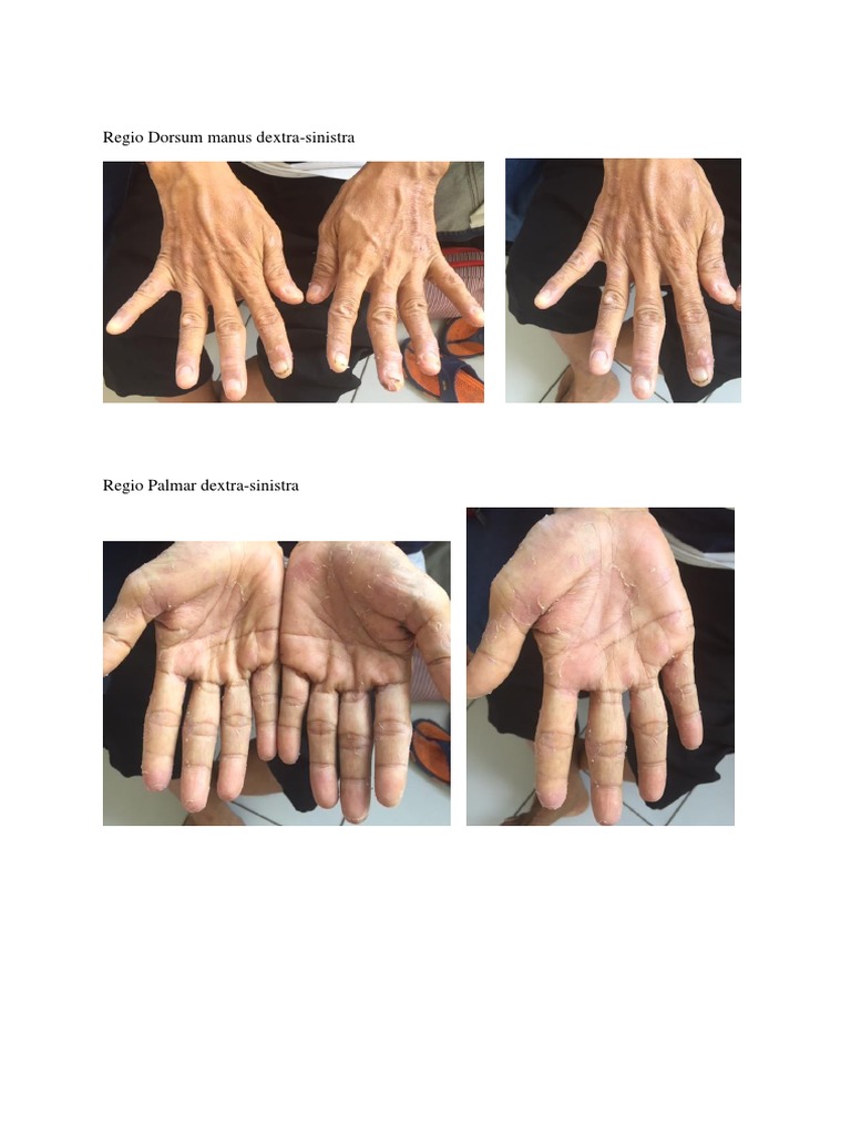 Regio Dorsum Manus Dextra | PDF