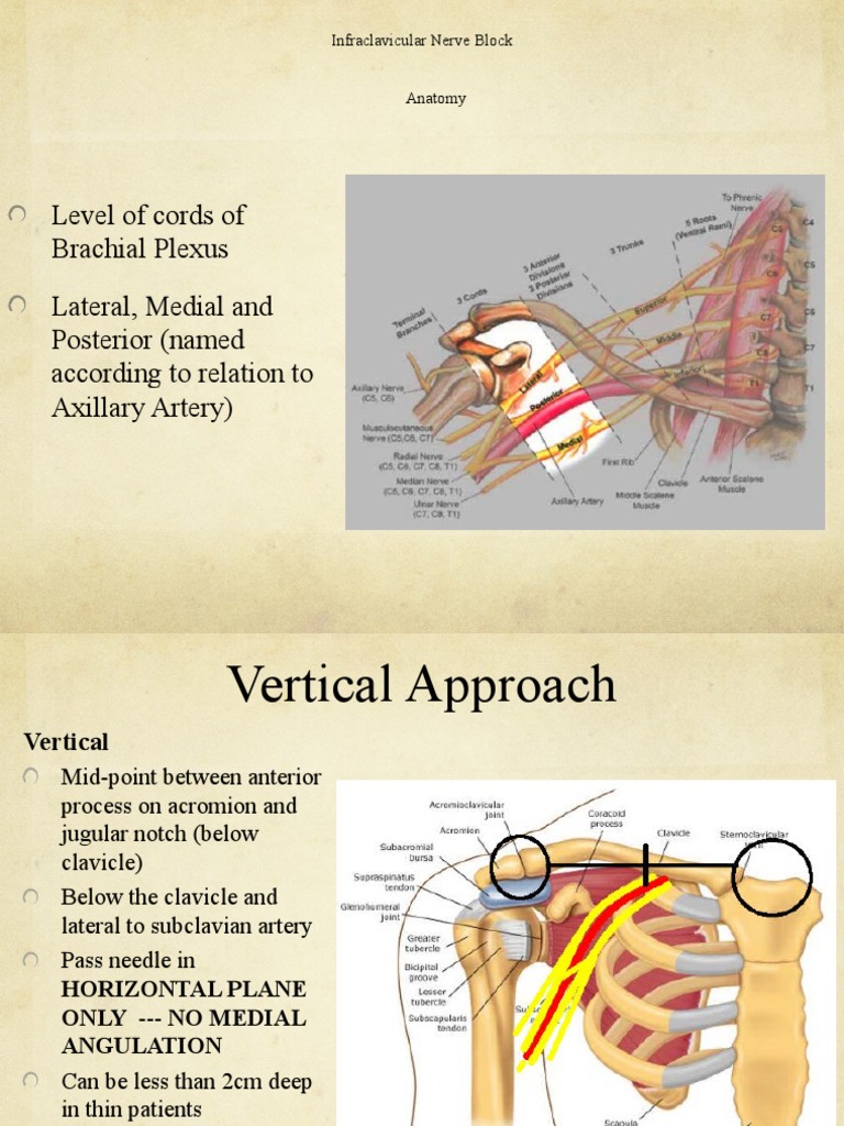 Infraclavicular Block PDF