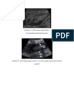 Gambar 2.5. USG Trauma Ginjal Grade 2 (Nonexpanding Peripenal Hematoma)