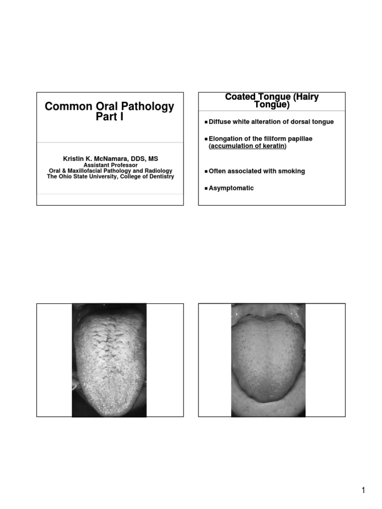 Common Oral Pathology Coated Tongue (Hairy Tongue) Coated Tongue