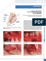 Kuna T. Et Al. Apikotomija PDF