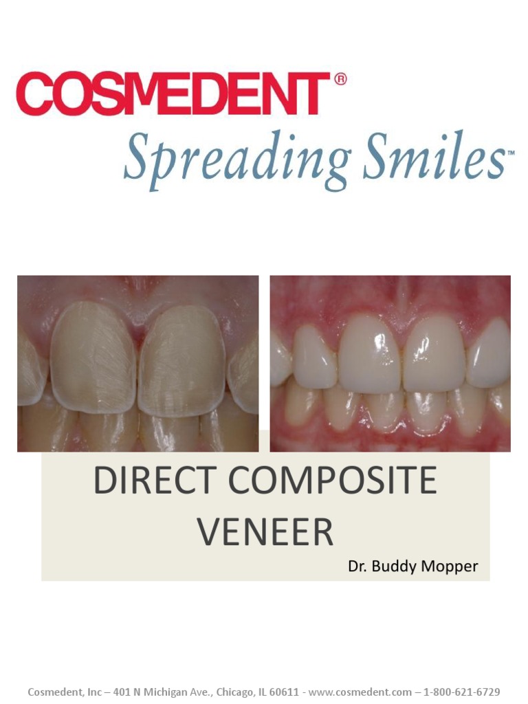 Direct Composite Veneer Technique Guide | PDF | Materials | Nature
