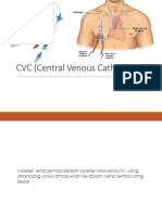 CVC (Central Venous Chatether)