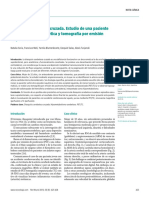 Diasquisis cerebelosa cruzada..pdf