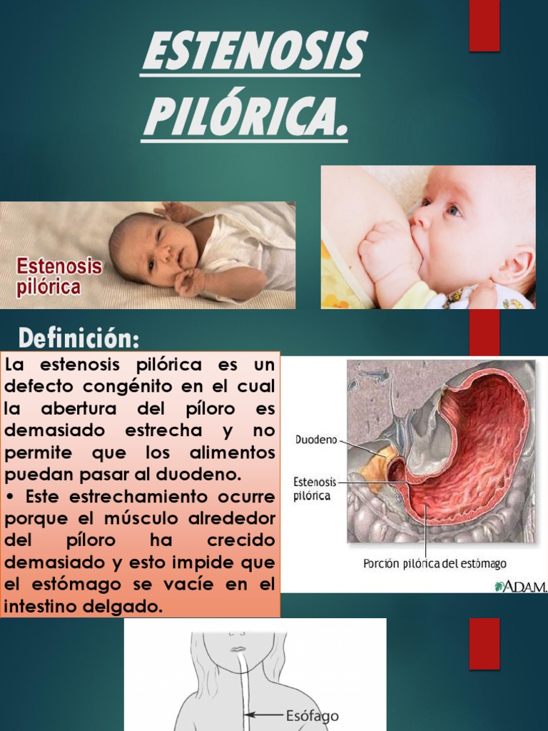 Síntomas y tratamiento de estenosis pilórica | PDF | Estómago ...