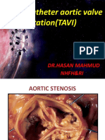 Transcatheter Aortic Valve Implantation (TAVI) : DR - Hasan Mahmud Nhfh&Ri