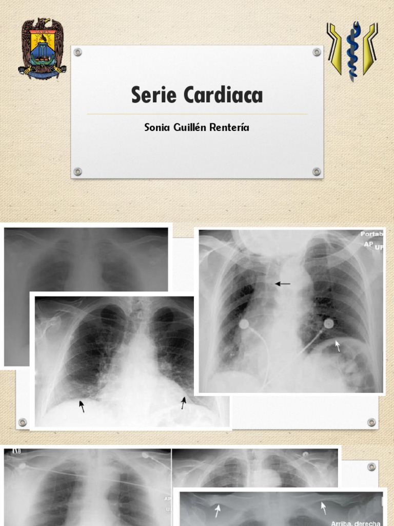 Signo del Muñeco de Nieve en RX Cardiaca | PDF | Pulmón | Corazón