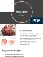 Anencephaly