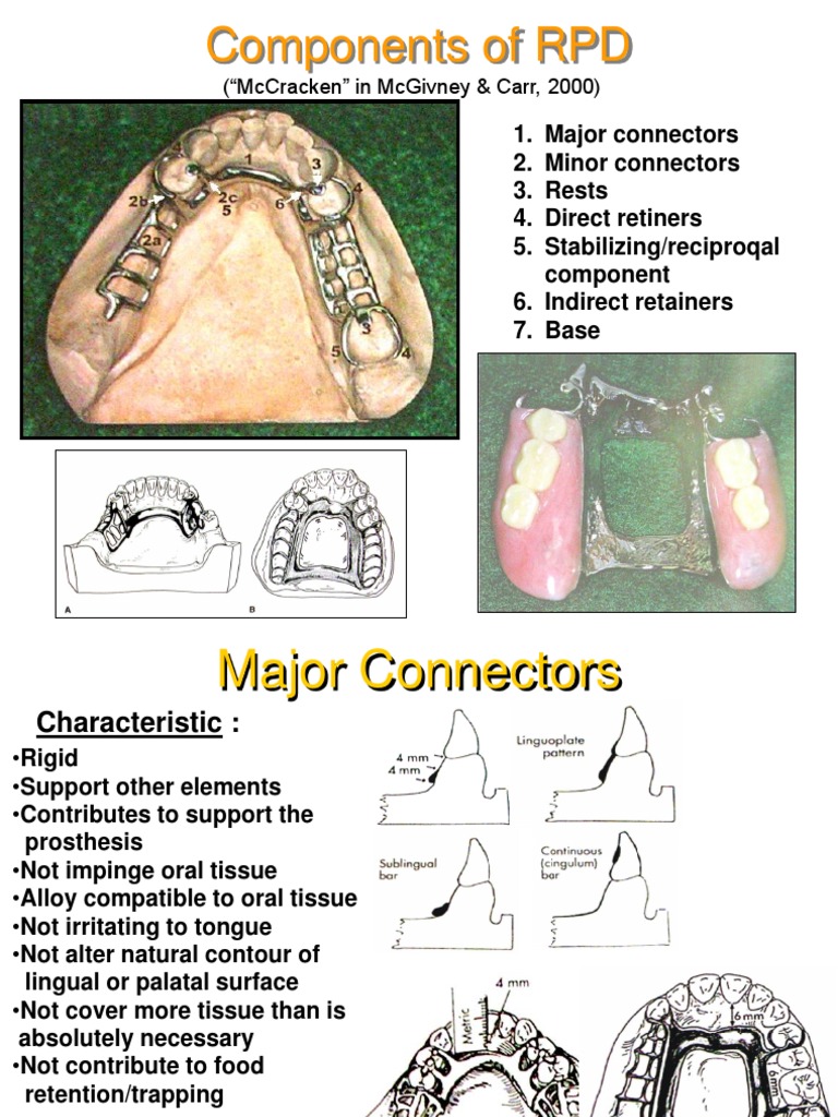 Key Components of RPD Design | PDF | Dentures | Mouth