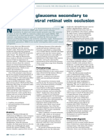 Neovascular Glaucoma Secondary To Ischaemic Central Retinal Vein Occlusion