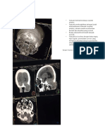 Ekspertise Radiologi Metastase Paru