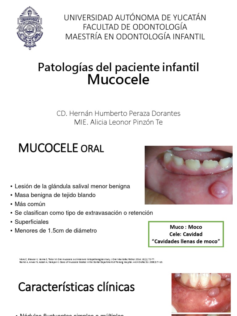 Mucocele Expo Boca Especialidades Medicas