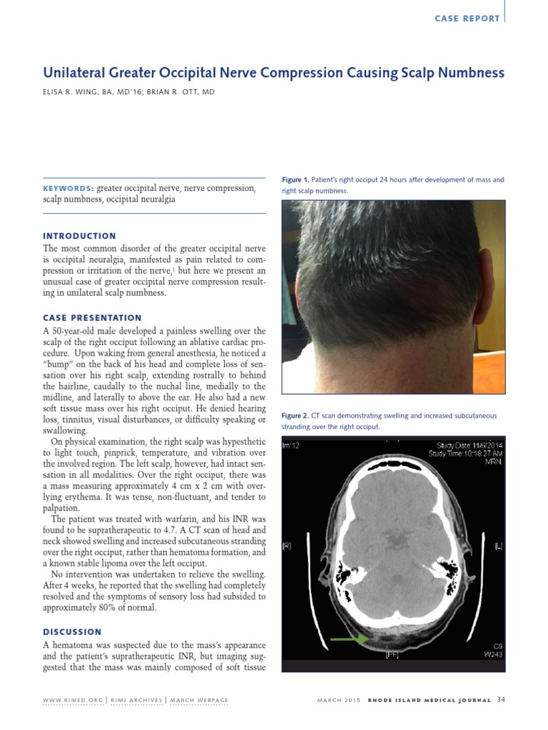 Unilateral Greater Occipital Nerve Compression Causing Scalp Numbness