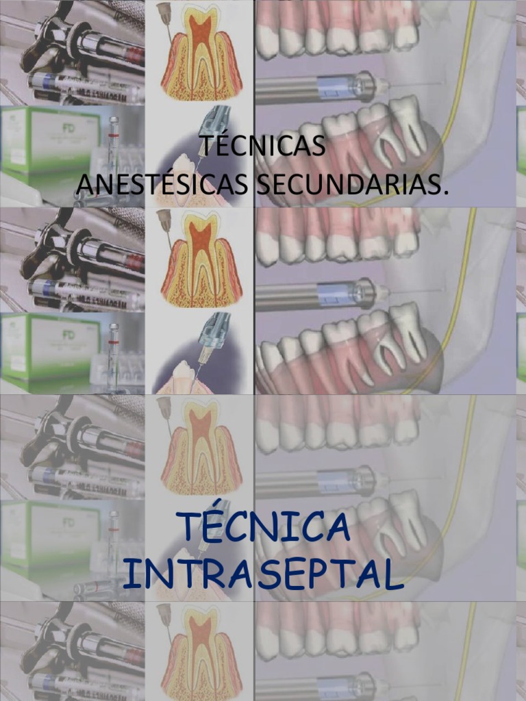 Técnicas de Anestesia Dental Intrapulpar | PDF | Anestesia | Odontología