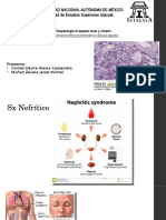 Glomerulonefritis Proliferativa Difusa Aguda