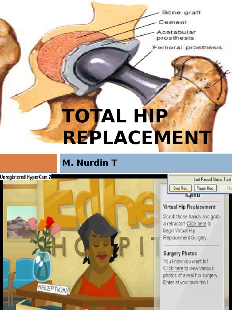 Total Hip Replacement PDF