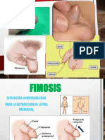 Fimosis: causas, síntomas y tratamiento