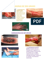 Quemaduras 2do y 3er grado: causas, síntomas y tratamiento