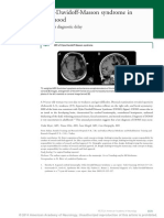 Dyke-Davidoff-Masson Syndrome in Adulthood: A 50-Year Diagnostic Delay