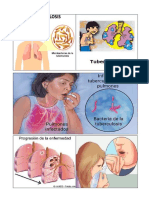 Dibujos Tuberculosis