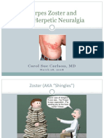 Zooster-Neuralgia Post Herpes
