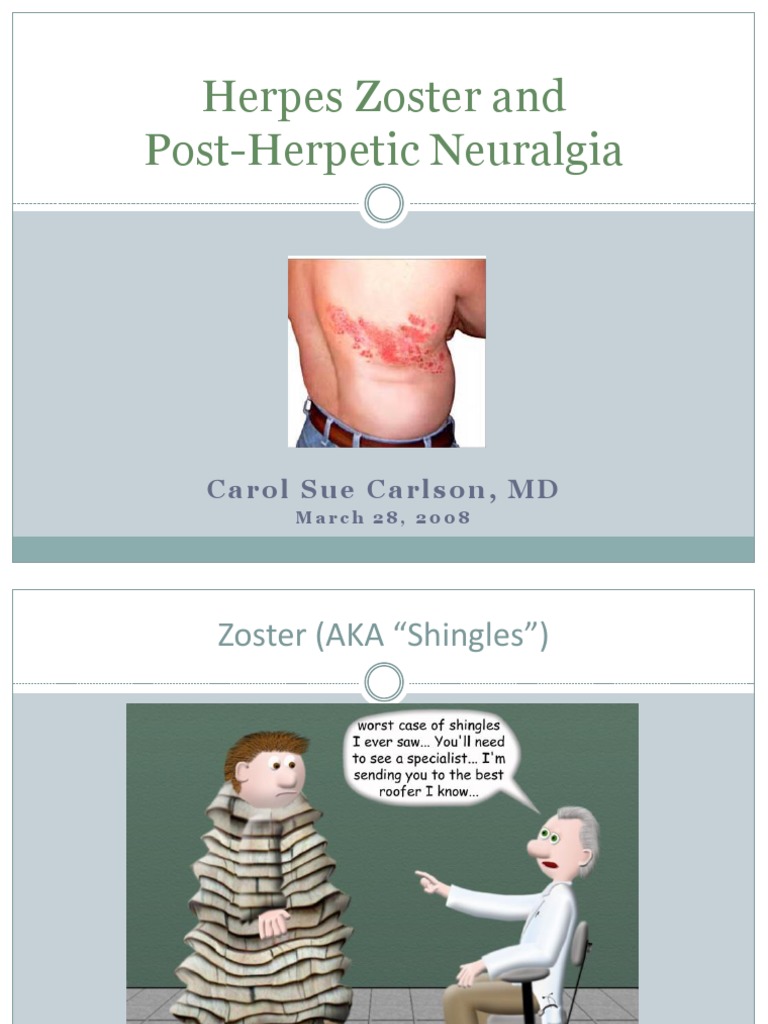 ZoosterNeuralgia Post Herpes PDF Analgesic Herpes Simplex