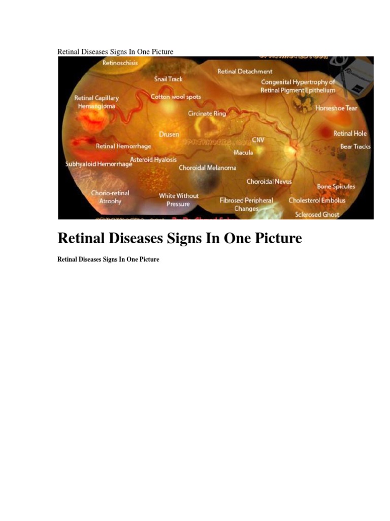 Opth Note | PDF | Retina | Diseases Of The Eye And Adnexa