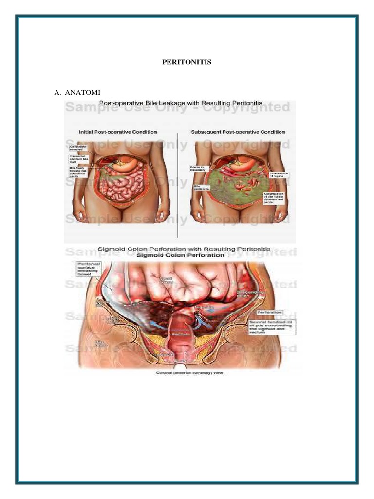 Peritonitis: Definisi dan Penyebabnya | PDF | Sains & Matematika