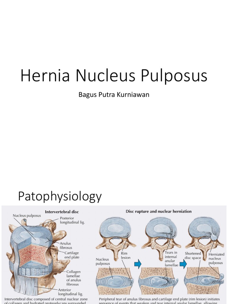 Hernia Nucleus Pulposus: Bagus Putra Kurniawan | PDF | Wellness