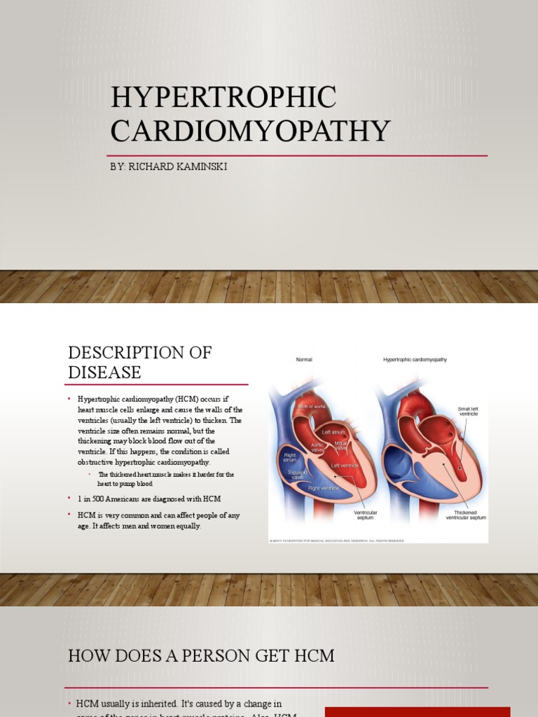 Hypertrophic Cardiomyopathy Powerpoint Pdf Heart Cardiovascular