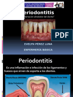 Inflamación alrededor del diente