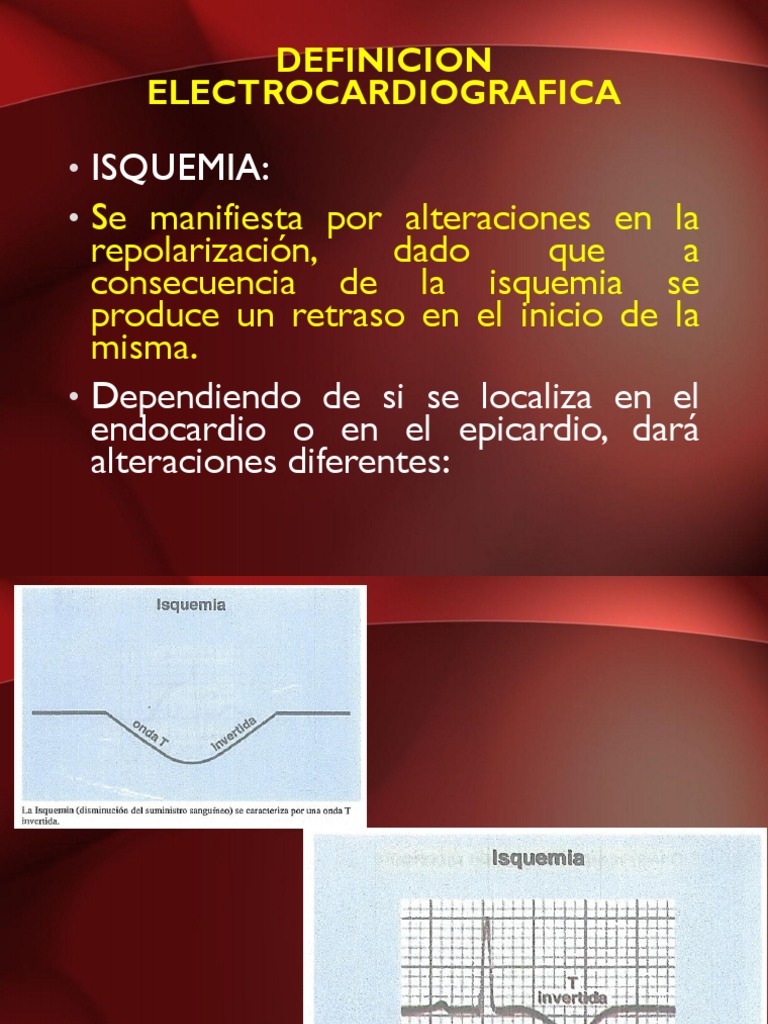 Ima 3 | PDF | Electrocardiografia | Infarto de miocardio