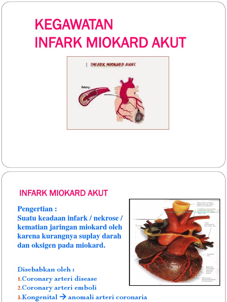 Lokalisasi Infark Miokard Akut | PDF
