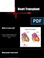 Heart Transplant