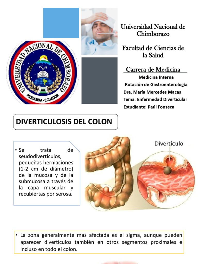 Enfermedad Diverticular | PDF | Rtt | Gastroenterología