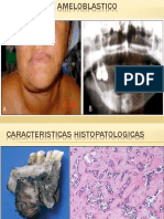 Carcinoma Ameloblastico
